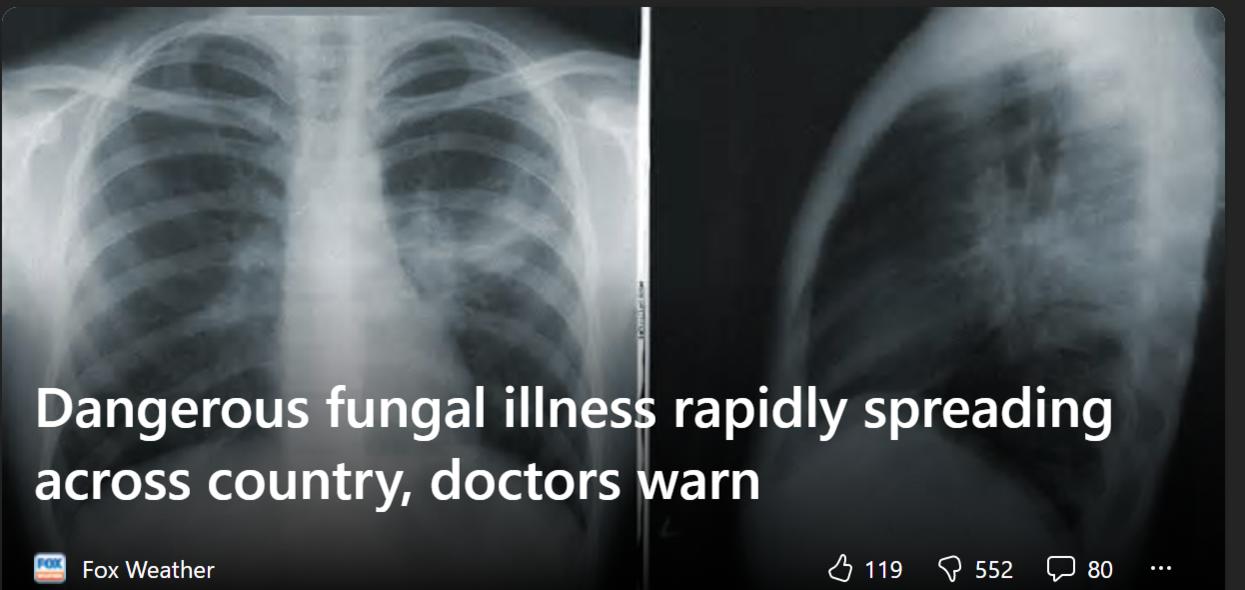 Bệnh nấm trong phổi nguy hiểm Valley Fever hay "cocci" lan nhanh khắp cả nước, bác sĩ cảnh báo